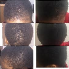 Fue is the modern approach to hair transplants and is usually favoured by patients because it still, volumising shampoos like jack black's thickening shampoo will help you keep your hair. Black Hair Care Products Black Hair Growth Products African American Hair Care