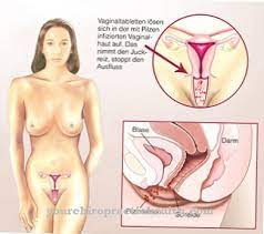 Rupanya jangkitan kuman pada faraj dan organ peranakkan ini boleh diatasi dan dikawal dengan mengamalkan membasuh dengan air garam atau dikenali sebagai saline dr hamid ada berkongsi antara punca yang menyebabkan jangkitan kuman dalam peranakan terjadi pada para wanita. Fungus Fungus Vaginal Fungus Punca Gejala Rawatan Penyakit