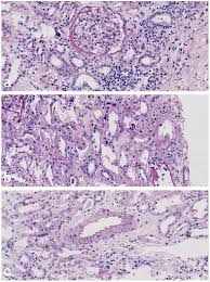 Maybe you would like to learn more about one of these? Dehydration Associated Chronic Kidney Disease A Novel Case Of Kidney Failure In China