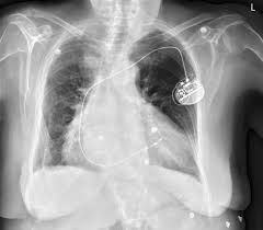 Heart pacemaker x ray stock photos and images. Cardiac Devices On Chest X Ray Chest X Ray Medschool