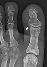 Maybe you would like to learn more about one of these? Fractures And Dislocations Of The Metatarsals And Toes Chapter 14 Broken Bones