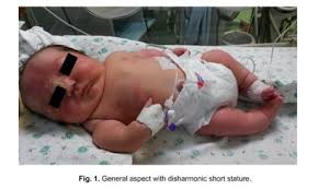 Campomelic dysplasia with dextrocardia and without sex-reversal