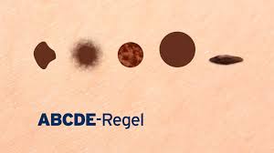 Maybe you would like to learn more about one of these? Hilfe Zur Selbsteinschatzung Leberfleck Schnellcheck Rbb