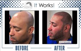 Scalp Micropigmentation Treatment Reviews