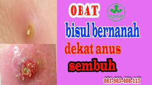 Pin Di Obat Fistula Ani