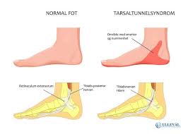 Det er frst nr tatoveringens eier former hnden p en spesiell. Har Du Vondt Under Foten Eller Haelen Ulleval Kiropraktorklinikk