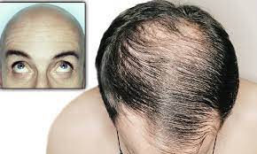 It may be that the stress of p. Male Baldness Thinning On Top It Could Be High Blood Pressure Daily Mail Online
