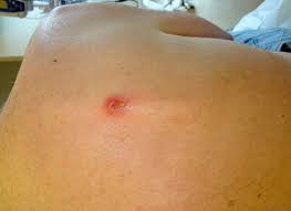 Staph infections—including those caused by mrsa—can spread in hospitals, other healthcare facilities, and in the community where you live, work, and go to school. Furuncle Caused By Methicillin Resistant Staphylococcus Aureus Mrsa Infection