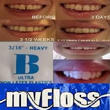 We did not find results for: Amazon Com Orthodontic Gap Teeth Bands 3 16 Heavy Floss 1 Pack Of 100 Beauty