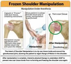 The Concern With Frozen Shoulder Manipulation Is The Development Of Scar Tissue Following The Procedure One Can Help Mini Frozen Shoulder Scar Tissue Shoulder