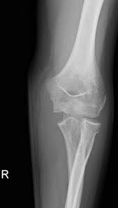 Medial epicondyle fractures represent almost all epicondyle fractures and occur when there is radiographic features. Intra Articular Displacement Of An Avulsed Medial Internal Epicondyle Ossification Centre In The Paediatric Elbow A Radiographic Finding Not To Be Missed Bmj Case Reports