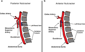 Posterior Nutcracker Syndrome A Case Report Journal Of Medical Case Reports Full Text