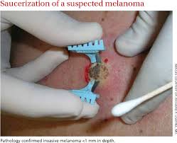 Pathologists are usually certain about their diagnoses. Biopsies For Skin Cancer Detection Dispelling The Myths Semantic Scholar