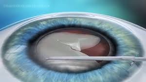 Augenlasern Bei Grauem Star Eyelaser In Wien Linz Graz