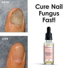 antifungal infection stop nail fungus