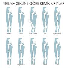 Kemik Kiriklari Prof Dr Alper Gokce