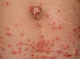 Skin Manifestations Of Tick Bites In Humans Sciencedirect