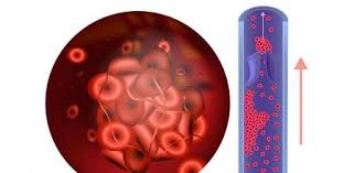 I get what you're trying to say, but that. Que Es La Trombofilia Sintomas Causas Y Como Tratar