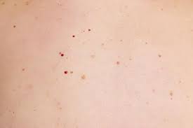 Red Moles On Skin Lovetoknow
