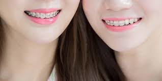 Gigi tonggos, gigi gingsul, gigi kelinci, atau gigi yang tidak beraturan bisa disebabkan oleh namun, untuk jenis metode ortodonti self ligating braces, khususnya damon clear terbilang naik dari tahun lalu. 6 Jenis Behel Untuk Atasi Gigi Tonggos