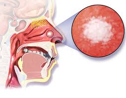 Head and neck cancers include several types of cancer that occur in the throat, oral cavity and nasal cavity. Nasal Cancer What Is It Symptoms Causes Prevention And Treatment Top Doctors