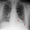 In many cases, lung cancer may also spread to other organs including the brain, adrenal glands, liver or bones and cause other symptoms that prompt seeking a medical evaluation. 1