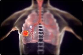 Engaged employees are more connected. Lung Cancer Screening Using Google Ai Proves To Be Successful