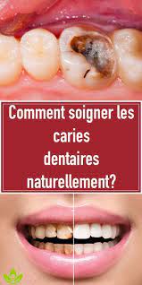 Comment Soigner Les Caries Dentaires Naturellement Reverse Cavities Tooth Decay Remedies Teeth Health