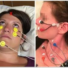 PDF) Meniere's Disease in Flight Crew