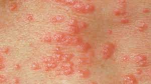 Herpes is an infection caused by the herpes simplex virus (hsv). Is It Herpes Or Something Else Everyday Health
