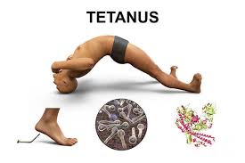 Image result for Tetanus