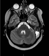 Image result for Mastoiditis