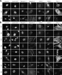 Es existieren bislang zwei vererbbare bekannte formen der krankheit. Immunohistochemistry On A Panel Of Emery Dreifuss Muscular Dystrophy Samples Reveals Nuclear Envelope Proteins As Inconsistent Markers For Pathology Neuromuscular Disorders
