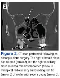 Image result for Maxillary Sinus