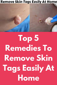 Thrombosed skin tags typically may fall off on their own in 3 to. Top 5 Remedies To Remove Skin Tags Easily At Home Today I Am Sharing With You Top 5 Home Remedi Skin Tags Home Remedies Skin Tag Removal Home Remedies For Skin