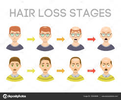 Information Chart Of Hair Loss Stages Types Of Baldness