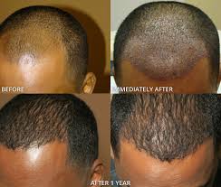 A wide variety of hair restoration men options are available to you, such as adults. Before And After Picutres Artas Robotic Hair Transplant