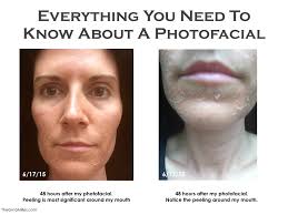 Everything You Need To Know About A Photofacial Read The Complete Review On Theginamiller Com Photofacial Ipl Photofacial Skin Care Dark Spots