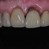 However, dentists usually use fillings that are the same color as the tooth. 1