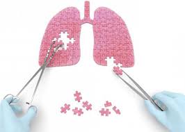 Die Operation An Der Lunge Arten Von Operationen Deren Folgen