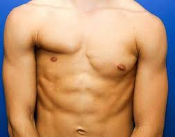 The disorder is primarily characterised by a deficiency in the development of the pectoral muscles in the chest. Poland Syndrome Malaysia Home Facebook