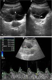 Ovarian cancer is the second most common gynecologic malignancy and is the fifth leading cause of the ultrasound appearance of benign and malignant ovarian lesions is shown in figures 1 hemorrhagic cysts can be diagnosed by the signal intensity of the hemorrhage within the cyst with. Sonographic And Doppler Predictors Of Malignancy In Ovarian Lesions Egyptian Journal Of Radiology And Nuclear Medicine Full Text