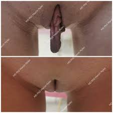 Labioplastyka Warszawa - najlepsze efekty