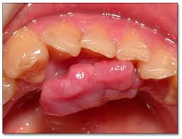 Image result for granuloma gum disease