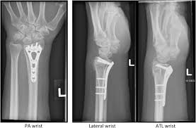Image result for Wrist XRay