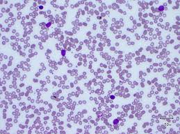 Their symptoms usually come on slowly, so you might not even notice them. Types Of Blood Cancer Leukaemia Foundation