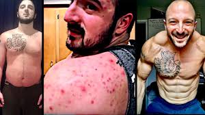 Trt before and after pics. Things I Wish I D Known Before Starting Trt Testosterone Replacement Therapy Youtube