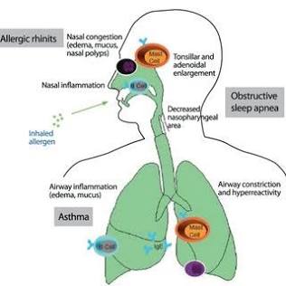 The physiological bridge connecting allergic rhinitis to airway restriction, AI generated