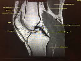 Involved early gray = muscle: The Knee Resource On Twitter A Lateral Knee Mri Explained Knee