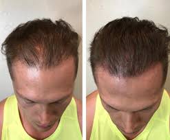 With those statistics in mind, you might be wondering how to stop hair loss in men. Scalp Micropigmentation Las Vegas Hides Thinning Hair Receding Hairline Ishapebrows